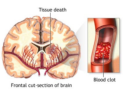 Then a junior, Katie Agresta suffered a stroke last year.  A stroke, sometimes called a brain attack, occurs when something blocks blood supply to part of the brain or when a blood vessel in the brain bursts. In either case, parts of the brain become damaged.